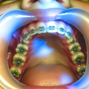 Orthodontie linguale: la solution discrète ?